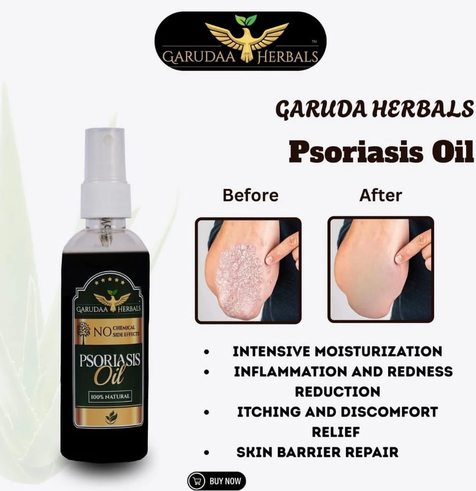 Psoriasis Herbal Oil